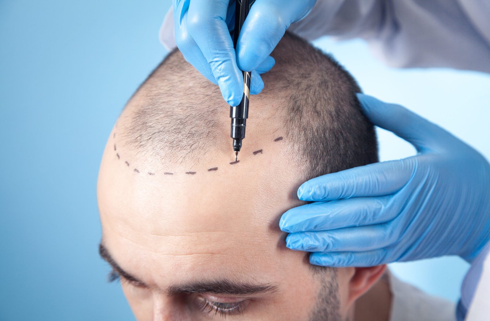 Hair transplant procedure